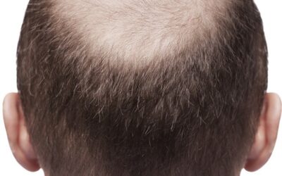 Dealing with Being Called Baldy in the Workplace